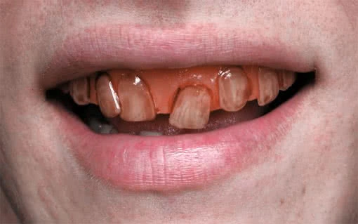 Rotten Goblin SFX Veneer ZĂ€hne